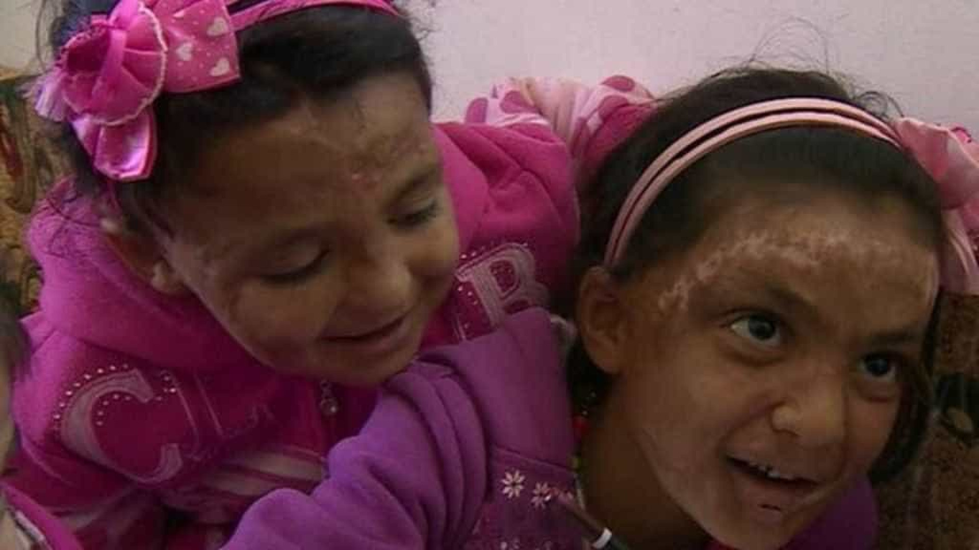 Irmãs sírias com rosto queimado na guerra. "Quero ser bonita como antes"