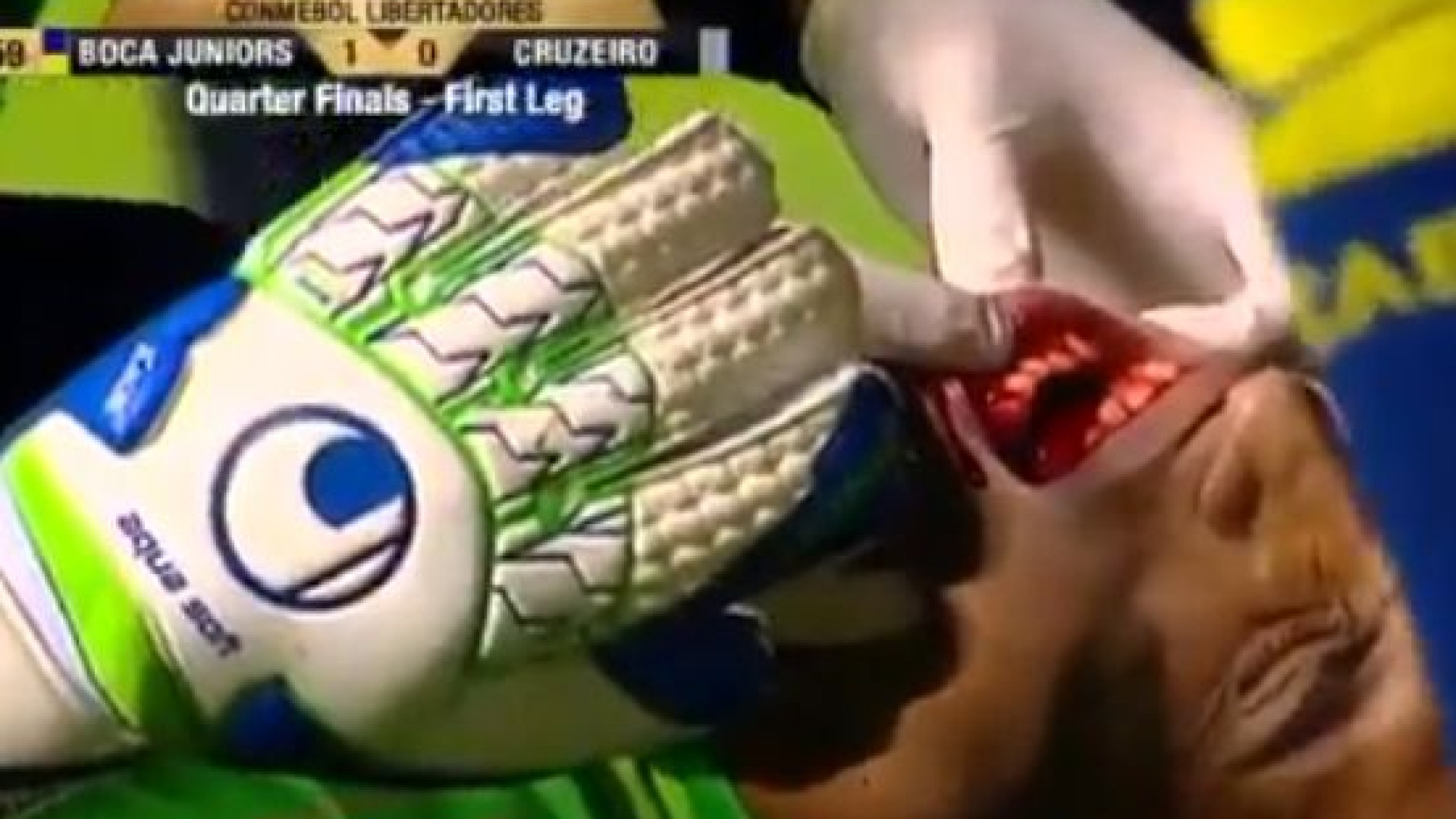 Guarda-redes do Boca ficou com maxilar fraturado após choque com defesa