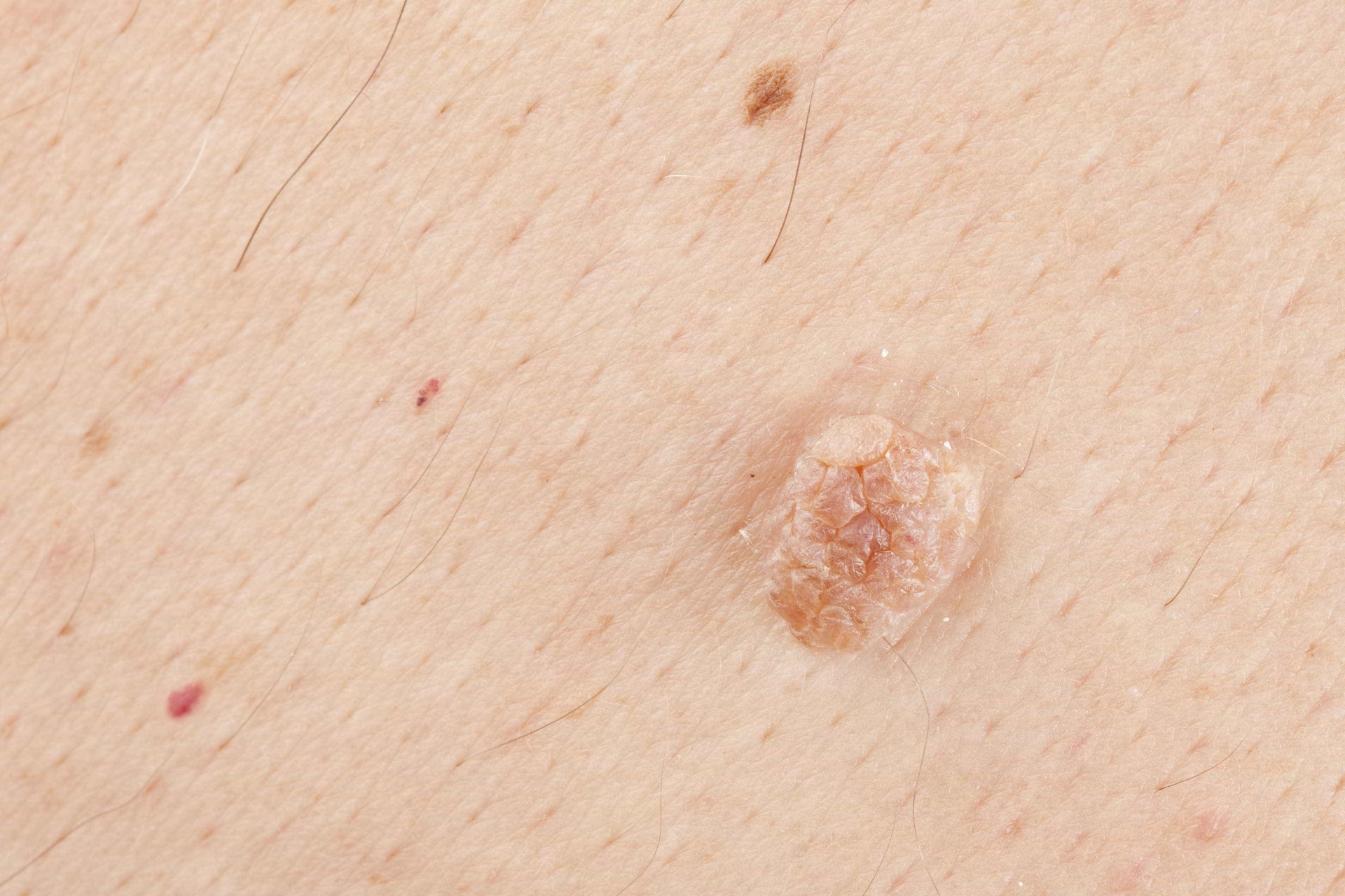 Saiba mais sobre o HPV e os seus tratamentos