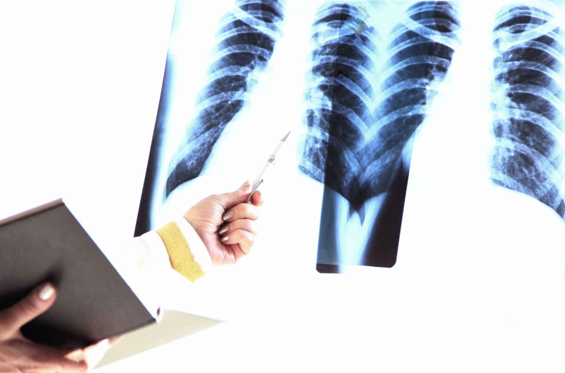 Osteoporose: conheça melhor esta 'doença silenciosa'
