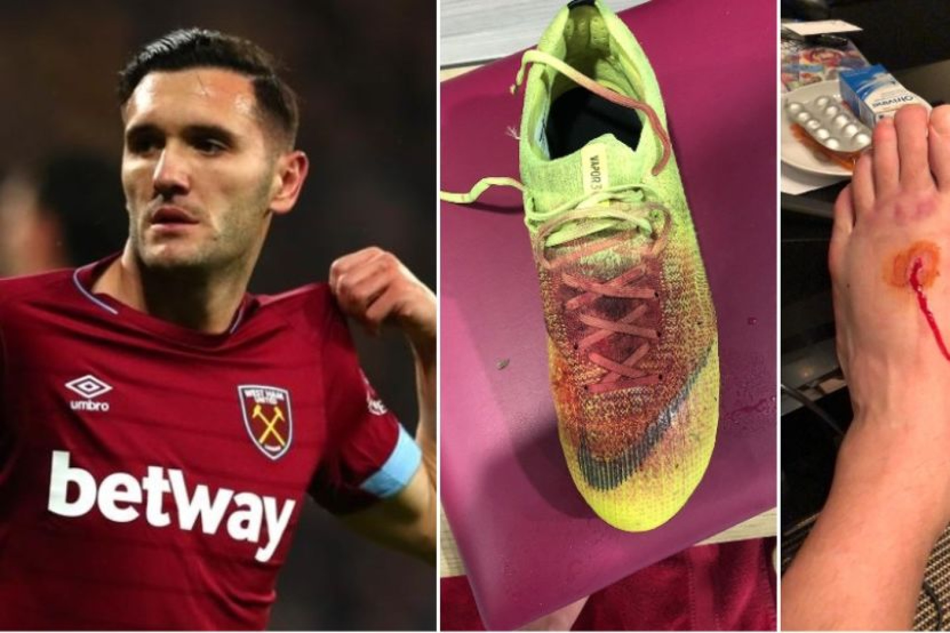 A arrepiante imagem do pé de Lucas Pérez após o jogo com o Palace