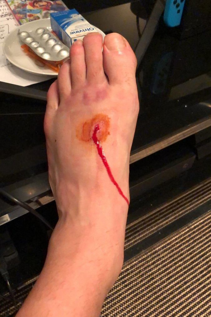 A arrepiante imagem do pé de Lucas Pérez após o jogo com o Palace